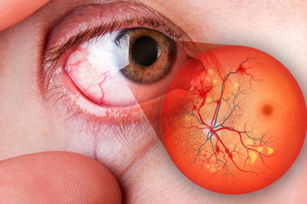 retinopatia