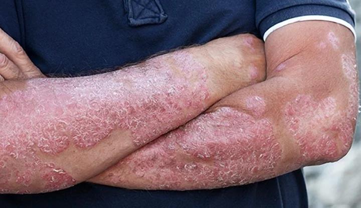6866-psoriasis